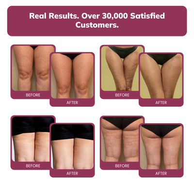 Limosia 3D Graduated Compression Leggings Lipedema